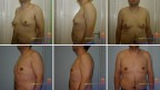 Gynecomastia